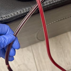 An image of the two iv lines showing the difference in color of the blood before and after EBOO therapy in Schaumburg at our clinic near you.