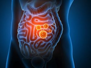 Intestinal parasites in the gut — physician-supervised parasite cleanse Chicago at Bliss MD